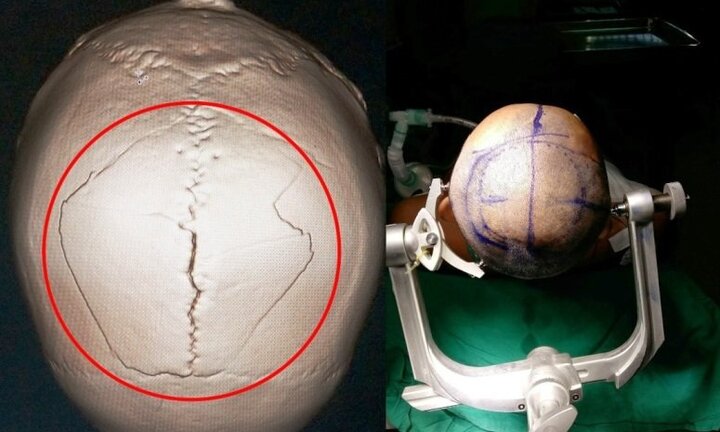 Nữ giáo sư hàng đầu thế giới đến Việt Nam mổ phình mạch não