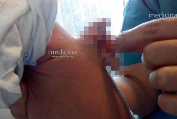 Cậu bé kỳ lạ sinh ra với 'vật lạ' gắn trên lưng