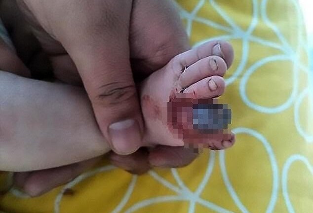 Bé trai nguy cơ mất ngón chân vì một sợi tóc