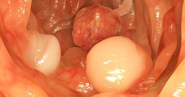 Những tuýp người dễ bị 'con quỷ' ung thư đại tràng viếng thăm