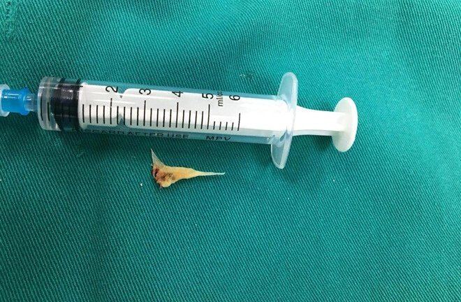 Xương cá nằm trong khí quản bệnh nhân suốt 2 tuần