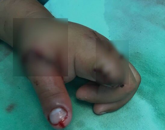 Bé trai 3 tuổi đứt lìa hai ngón tay vì xích xe máy