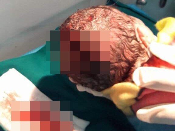 Thai nhi bị rách đầu vì mẹ chồng dùng dao giúp con dâu tự đẻ tại nhà