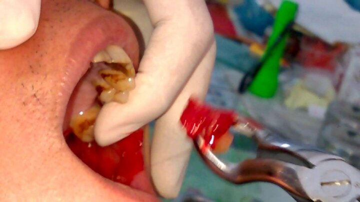 Răng số 8 là gì, răng số 8 mọc lệch có nên nhổ không?