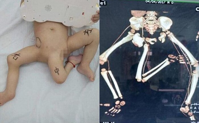 Kỳ lạ: Cậu bé sinh ra có 3 chân khác người