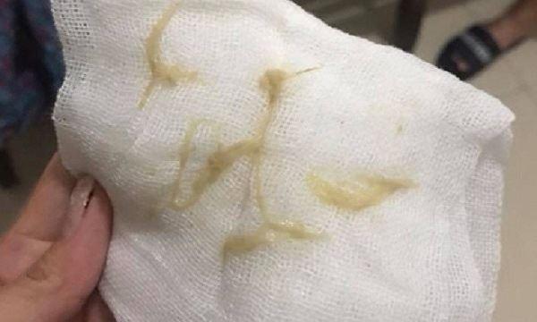 Bé 22 tháng tuổi tím tái, nguy kịch vì hóc giấy ăn