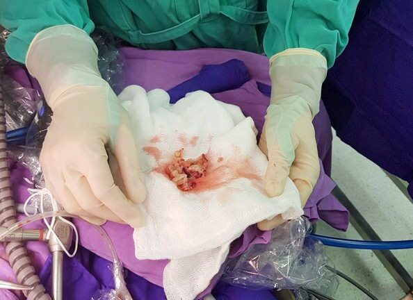 Đau bụng kèm sốt, bé gái 3 tuổi mắc bệnh hiếm gặp