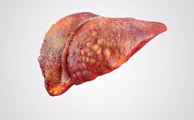 6 dấu hiệu cảnh báo gan đang 'yếu' đi từng ngày