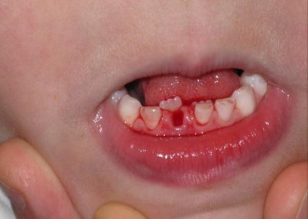 Ngã gãy răng không nên vứt vì có thể cắm lại