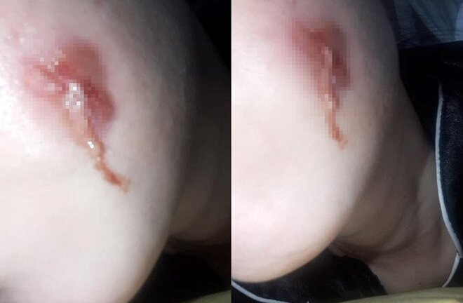 Cô gái bị nhiễm trùng vì tạo hình má lúm tại spa