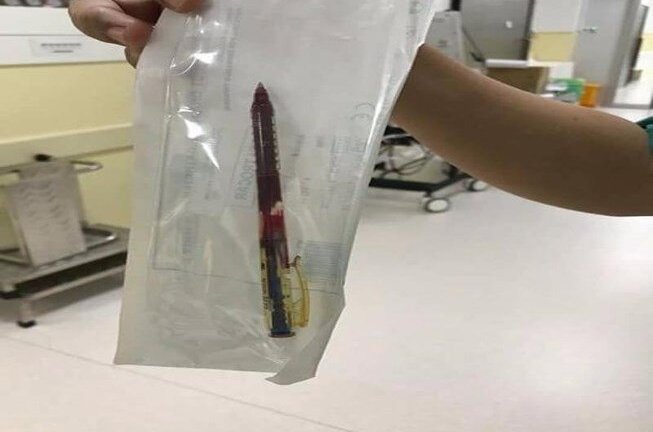 Tội nghiệp bé gái 4 tuổi vấp ngã bị bút bi đâm thấu ngực