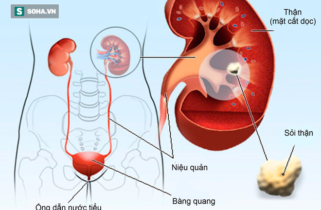 4 giải pháp chăm sóc thận không tốn kém lại hiệu quả