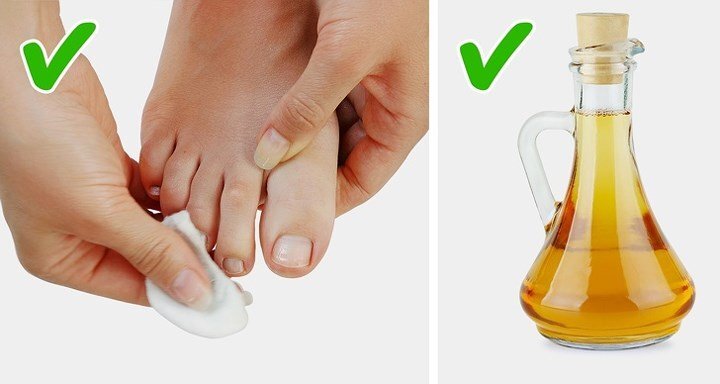 Những cách tự nhiên chữa móng chân mọc lệch đâm vào da thịt