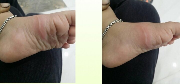 Về quê nghỉ hè, bé gái bị giun kí sinh đào hang bò lúc nhúc dưới da