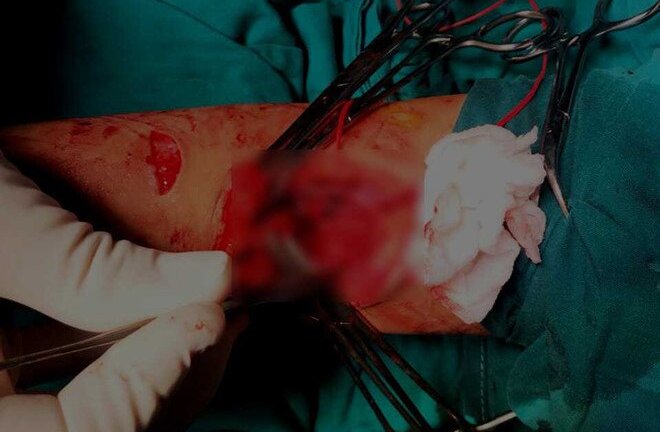 Lần đầu cứu sống bé gái 4 tuổi rơi từ tầng 7 chung cư