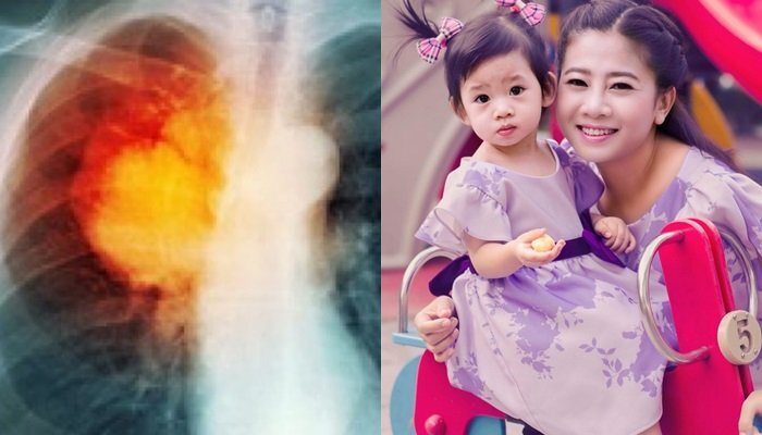 Ung thư phổi là gì, ung thư phổi có chữa được không?