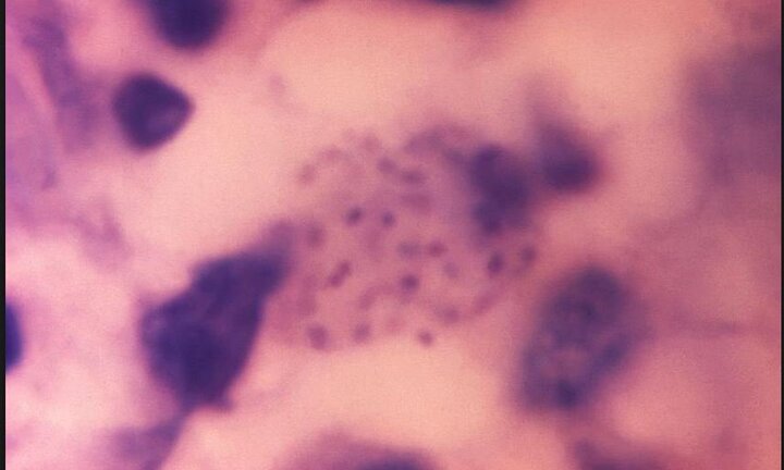 Cô gái nhiễm vi khuẩn ăn thịt người qua đường tình dục