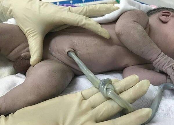 Người mẹ mang thai 40 tuần suýt mất con vì cố gắng sinh thường