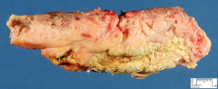 Bệnh viện Chợ Rẫy bị tố: Bệnh nhân viêm tụy cấp 99% mất mạng nếu hoại tử đa tạng