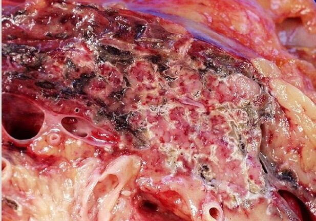 Bệnh viện Chợ Rẫy bị tố: Những hình ảnh đáng sợ khi tụy tự tiết ra enzyme 'ăn' chính mình