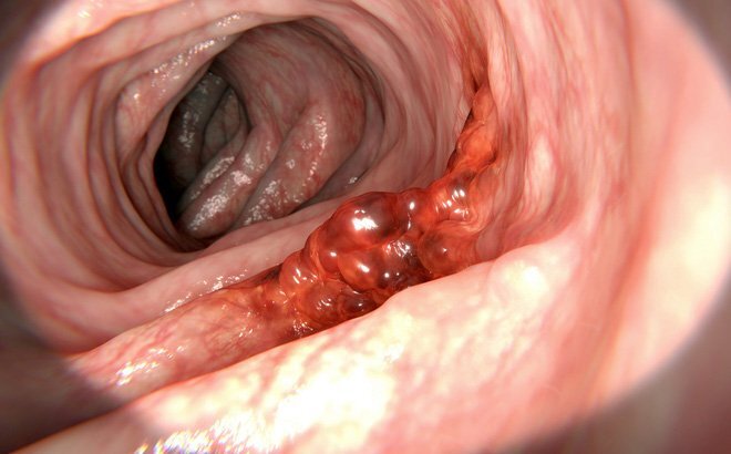 5 thói quen ăn uống người Việt nào cũng mắc dễ gây ung thư dạ dày