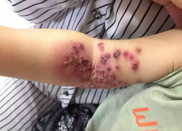 Bé gái 18 tháng tuổi sưng rộp, lở loét cánh tay vì nụ hôn của mẹ