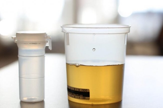 Người đàn ông mắc bệnh lạ, bác sĩ phải lọc nước tiểu để lấy tinh trùng