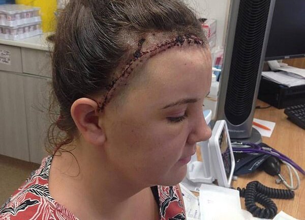 Cô gái 24 tuổi đột ngột bị mù do bỏ qua dấu hiệu này