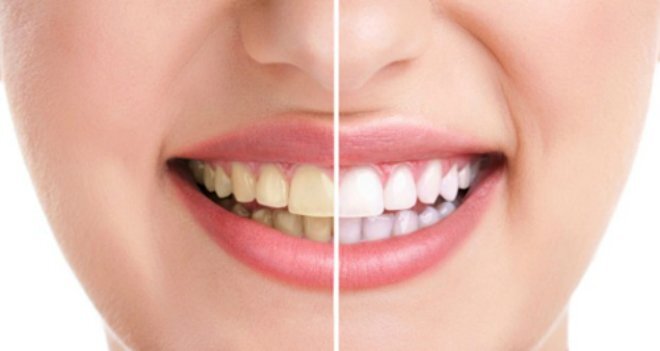 5 tác nhân khiến hàm răng trắng sáng trở nên ố vàng