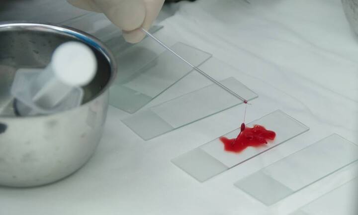 Cứu tinh cho bệnh nhân ung thư phổi: Vừa nội soi phế quản siêu âm vừa sinh thiết