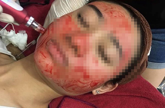 Sự thật về các phương pháp 'cấy' tinh chất, lăn kim trẻ hóa da