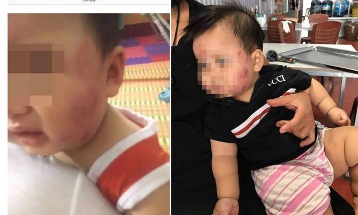 Bé 11 tháng tuổi bị cắn khắp mặt: Nhóm trẻ mầm non hoạt động chui