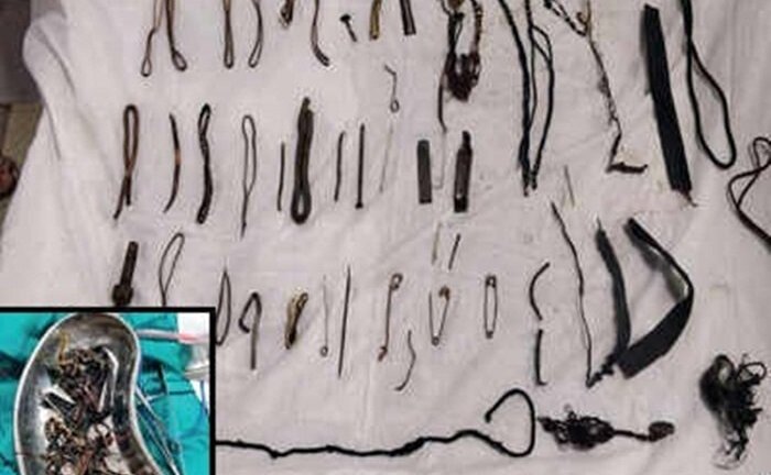 Bác sĩ lấy búi kim loại nặng 1,5kg trong dạ dày người phụ nữ