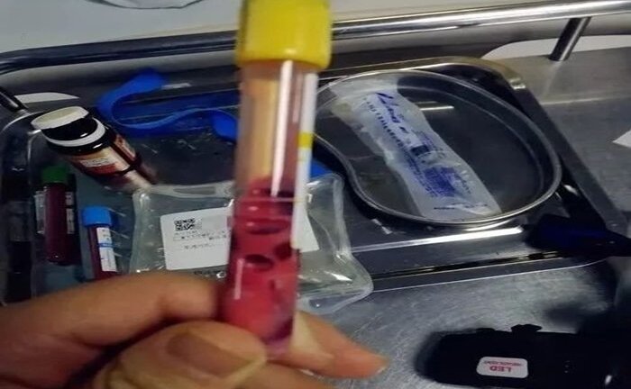 Bác sĩ 'hoảng sợ' khi máu bệnh nhân có màu hồng kỳ quái