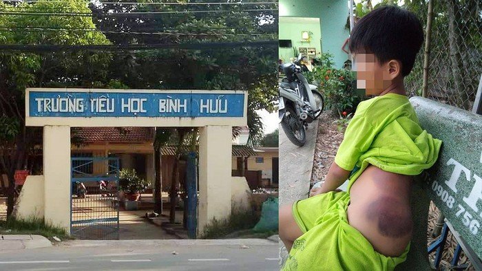 Học sinh khuyết tật 7 tuổi bị đánh bầm tím: Phụ huynh tha thứ cho cô giáo