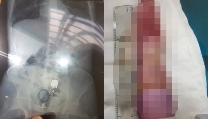 Đồ chơi người lớn mắc kẹt trong hậu môn, nam thanh niên tắc ruột suýt chết