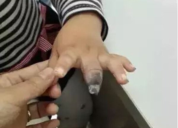 Dán urgo sai cách, bé gái 4 tuổi phải cắt bỏ hai đốt ngón tay