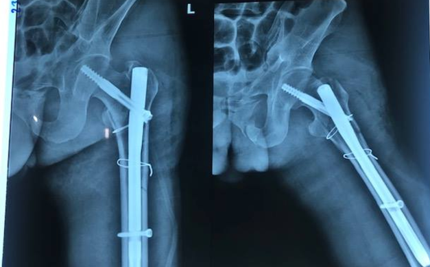 Ba kíp mổ hợp sức cứu bệnh nhân bị đa chấn thương do ngã từ độ cao 8 mét