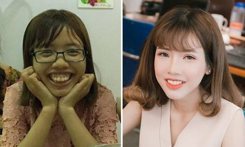 Cô gái Bắc Ninh sở hữu ngoại hình xinh đẹp sau 24 năm bị chê 'ba môi'