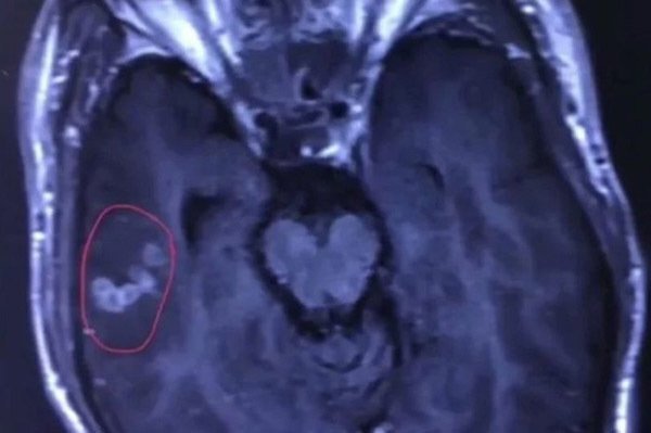 Sán dây 10cm ngoe nguẩy trong não chàng trai trẻ ở Trung Quốc