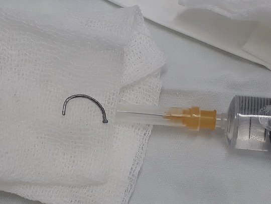 Người đàn ông bị đinh dài 2,5cm cắm sâu vào mắt