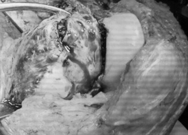 Nhiều bệnh nhân bị u tế bào khổng lồ ăn mục xương mà không biết