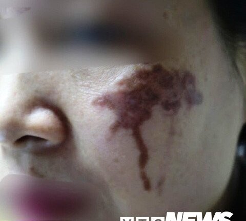 ‘Rước họa vào thân’ vì tin lời quảng cáo có thể trị nám bằng axit