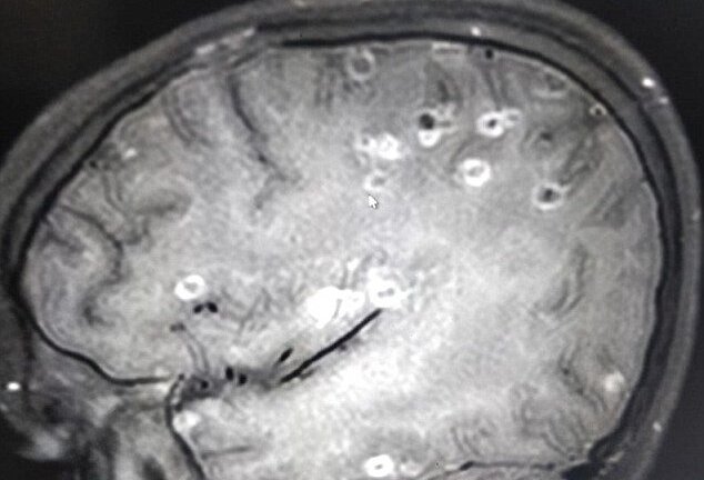 Trứng sán từ dạ dày 'chạy' lên não theo đường máu, cô bé có 100 trứng sán dây trong đầu