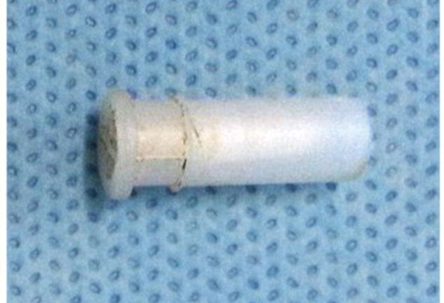 Nuốt phải đồ chơi, phổi cậu bé 4 tuổi phồng to hơn quả bóng