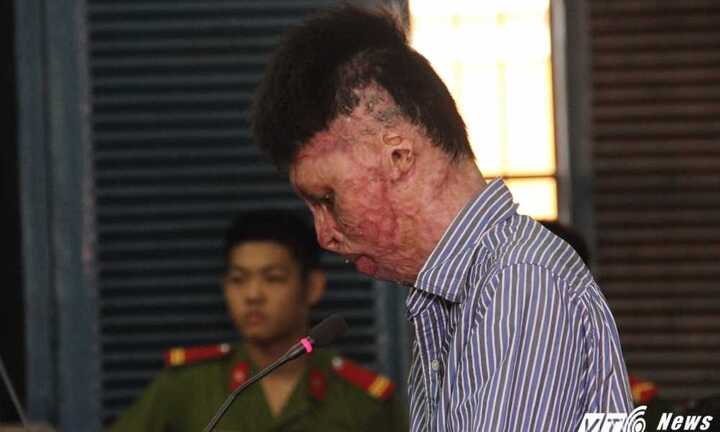 18 năm tù cho kẻ đốt tự đốt mình và người yêu