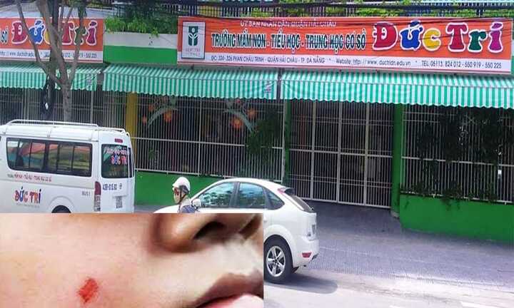 Cô giáo đánh xước má học sinh bị phạt 5 triệu đồng, đình chỉ công tác