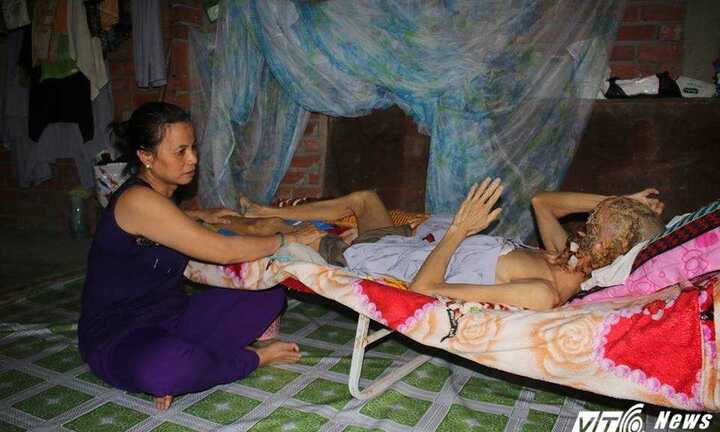 Người đàn ông mắc bệnh lạ bị ăn hết khuôn mặt: Vợ đau đớn mong chồng sớm được ‘ra đi’
