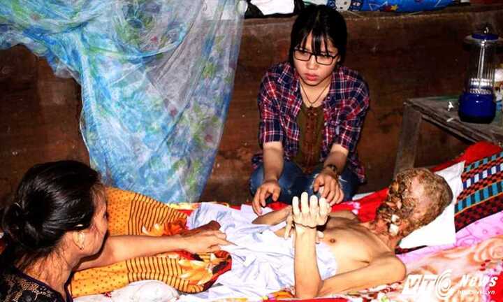 Người đàn ông mắc bệnh lạ bị ăn hết khuôn mặt ở Tiền Giang vẫn có thể được chữa khỏi