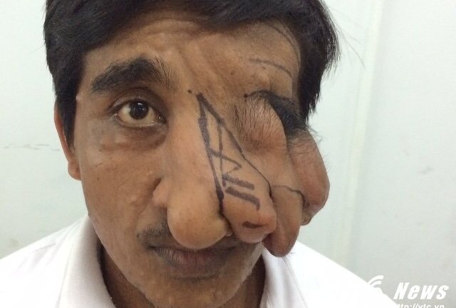 Chàng trai Khmer có khối bướu kỳ dị lủng lẳng gần 20 năm trên khuôn mặt